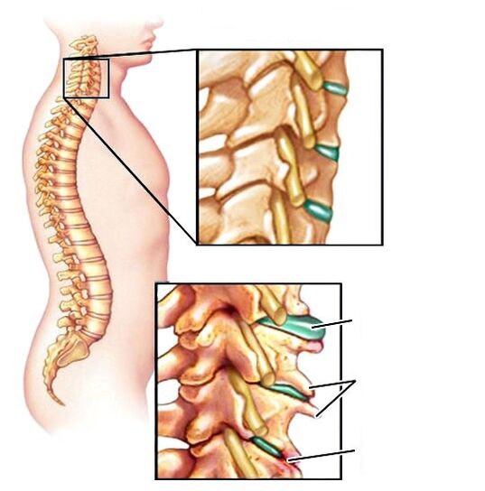 Colonna vertebrale sana e osteocondosi danneggiata