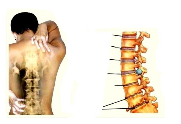 Fase di sviluppo dell'osteocondosi