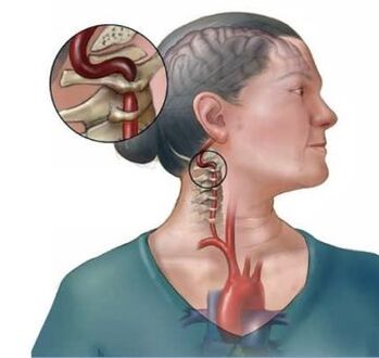 L'osteocondosi cervicale porta alla distruzione dei dischi intervertebrali della colonna vertebrale