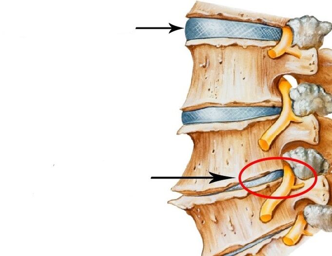 disco danneggiato e nervo violato con osteocondosi cervicale