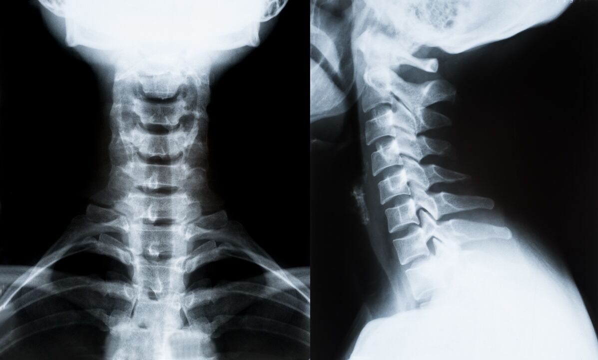 osteocondrosi cervicale alla radiografia