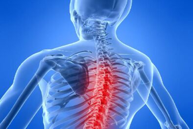 Compressione del midollo spinale nell'osteocondrosi toracica